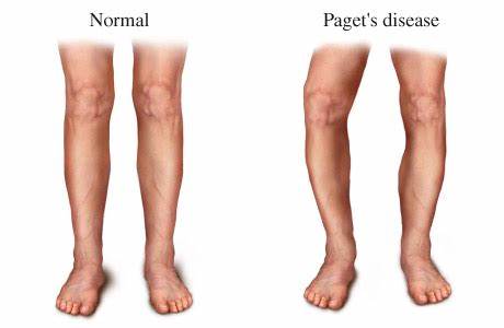 comparison-of-normal-legs-and-ones-with-pagets-disease