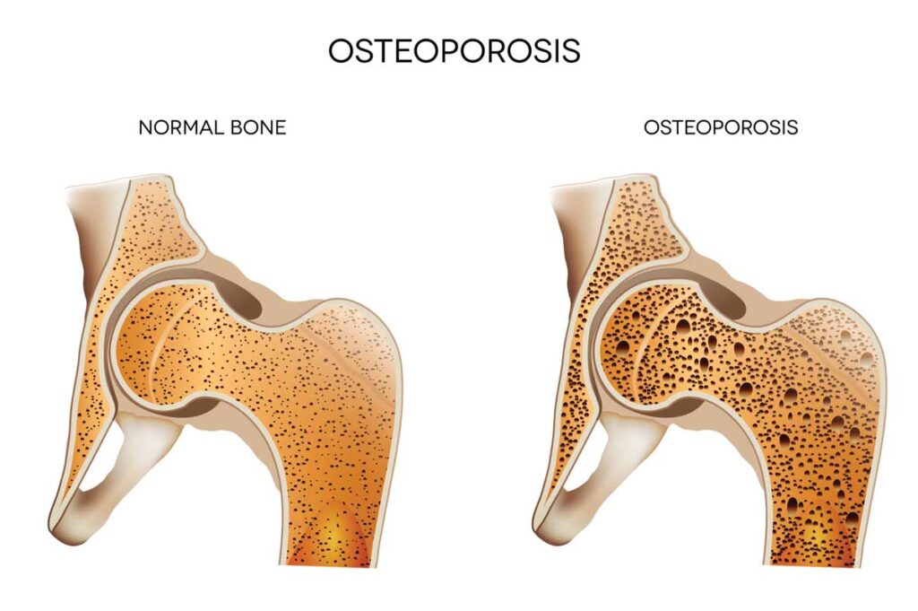 comparison-of-normal-bone-and-one-with-osteoporosis